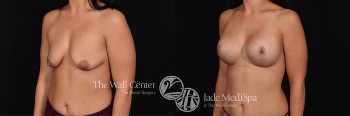 Before & After Breast Augmentation with Lift Case 689 VIEW #2 View in Shreveport, LA