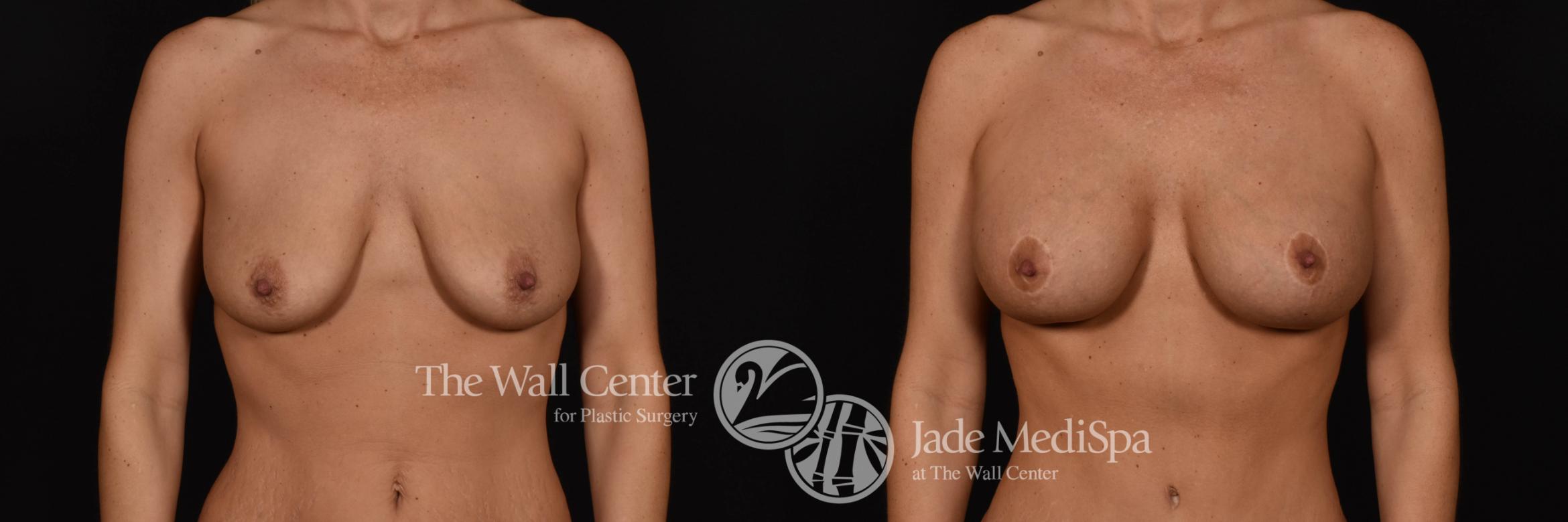 Breast Aug with Lift Front Photo, Shreveport, Louisiana, The Wall Center for Plastic Surgery, Case 926
