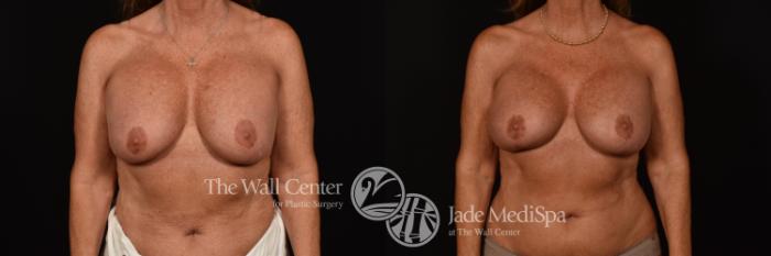 Before & After Breast Implant Exchange Case 1101 Front View in Shreveport, LA
