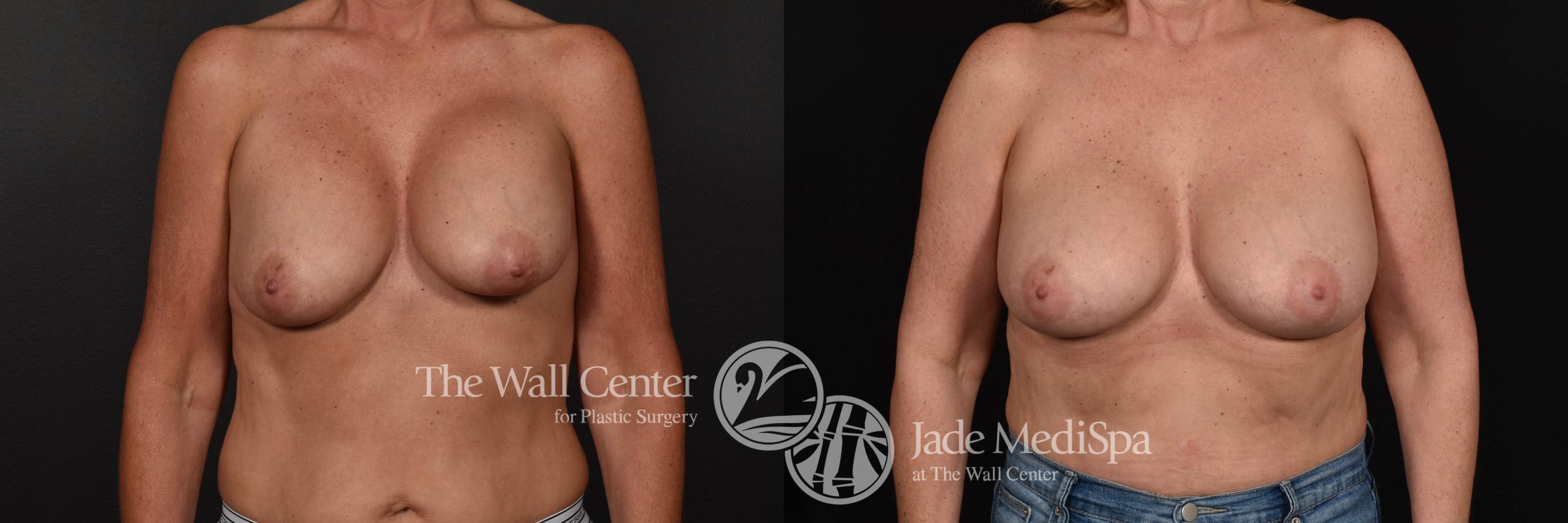 Breast Implant Exchange Front Photo, Shreveport, Louisiana, The Wall Center for Plastic Surgery, Case 889