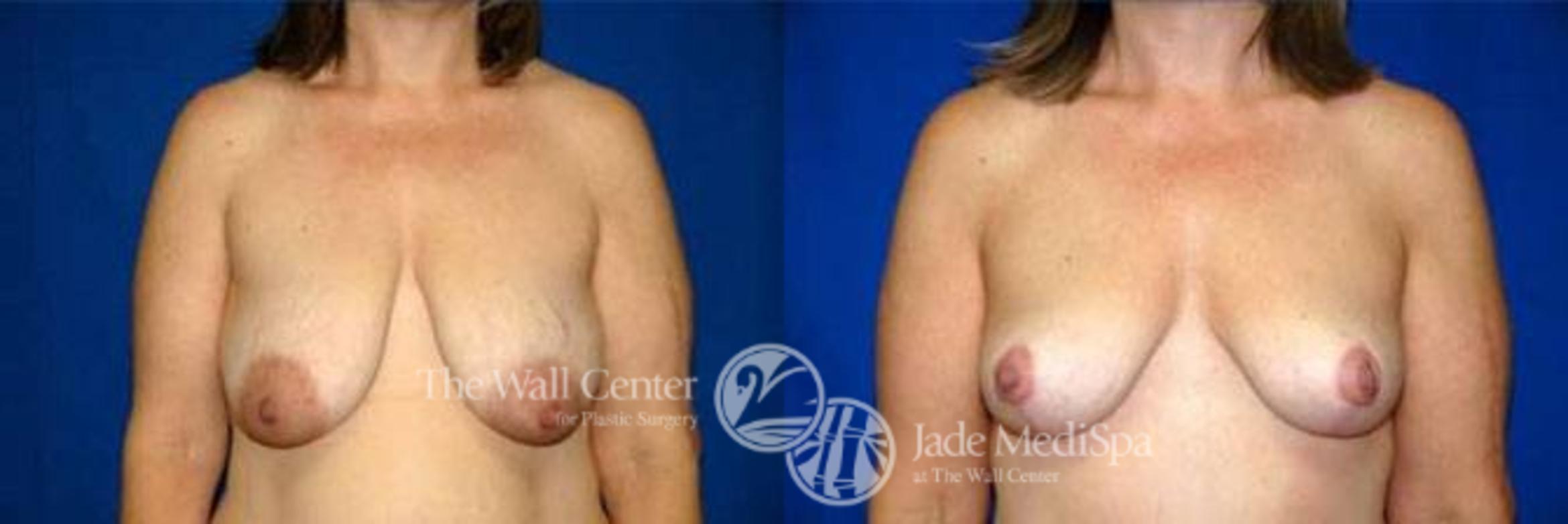 Before & After Breast Lift Case 122 View #1 View in Shreveport, LA