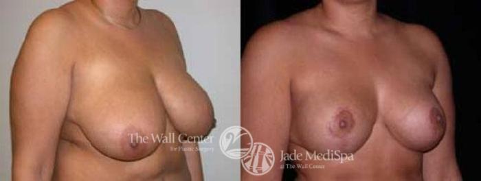 Before & After Breast Lift Case 64 View #2 View in Shreveport, LA