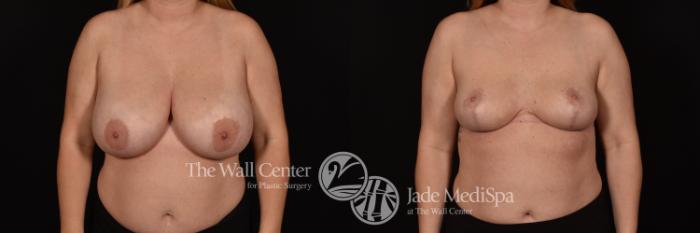 Before & After Breast Reduction Case 1065 Front View in Shreveport, LA