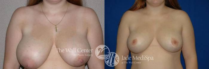Before & After Breast Reduction Case 202 View #1 View in Shreveport, LA