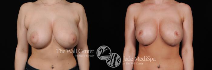 Before & After Breast Reduction Case 545 View #1 View in Shreveport, LA