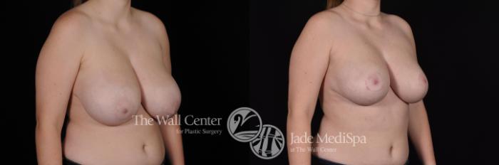 Before & After Breast Reduction Case 610 View #2 View in Shreveport, LA