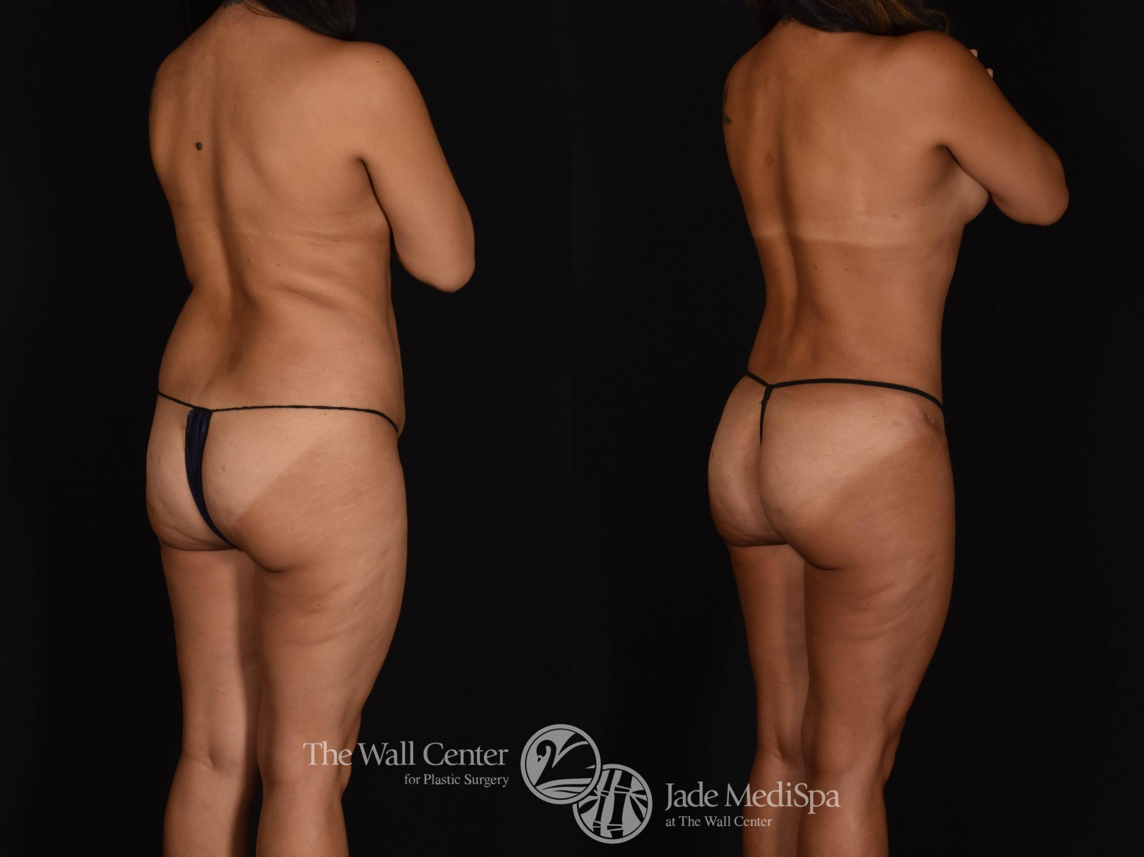Before & After Buttock Augmentation Case 785 VIEW #1 View in Shreveport, LA