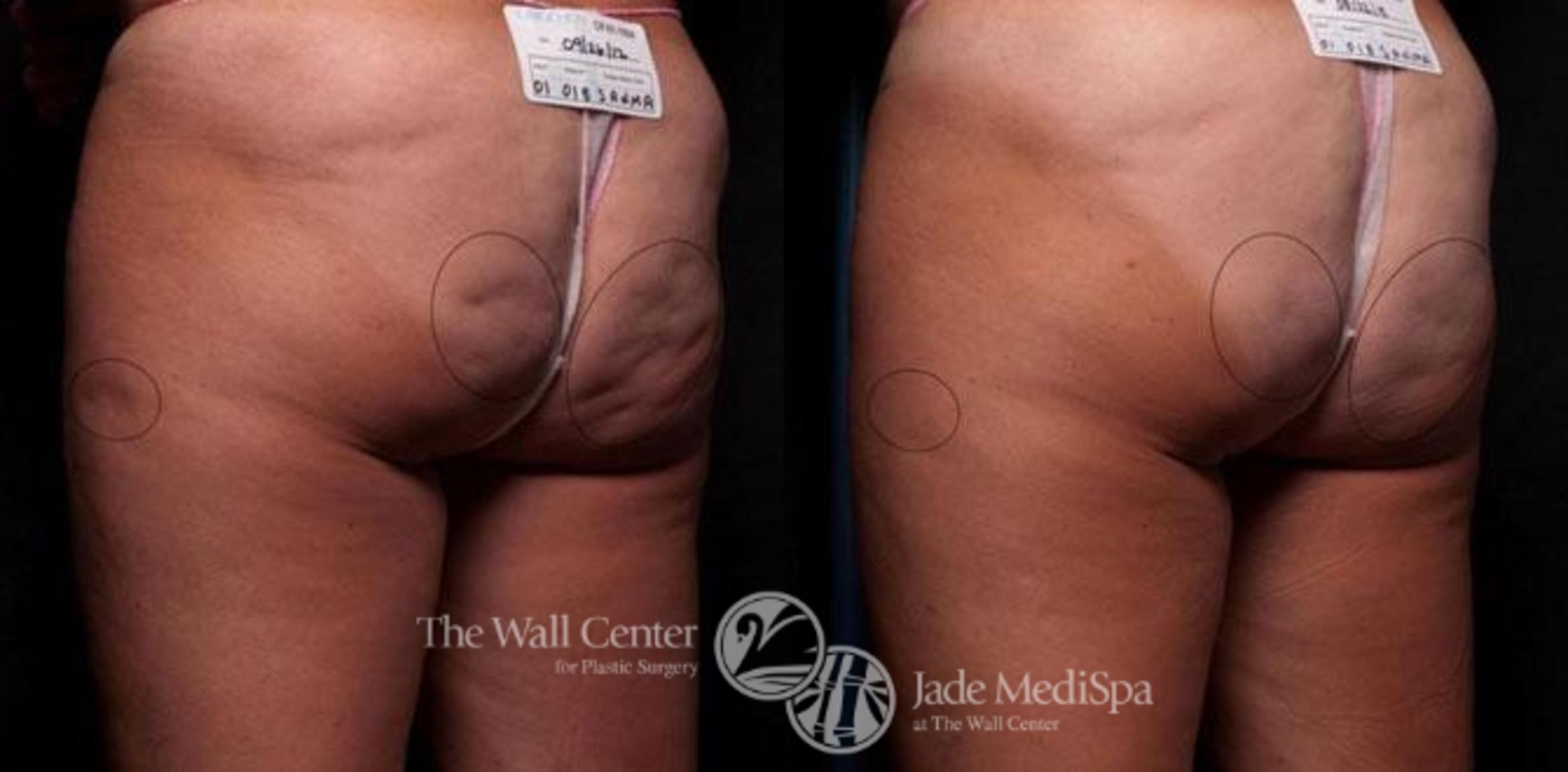 Cellfina Case 329 Before & After View #1 | Shreveport, LA | The Wall Center