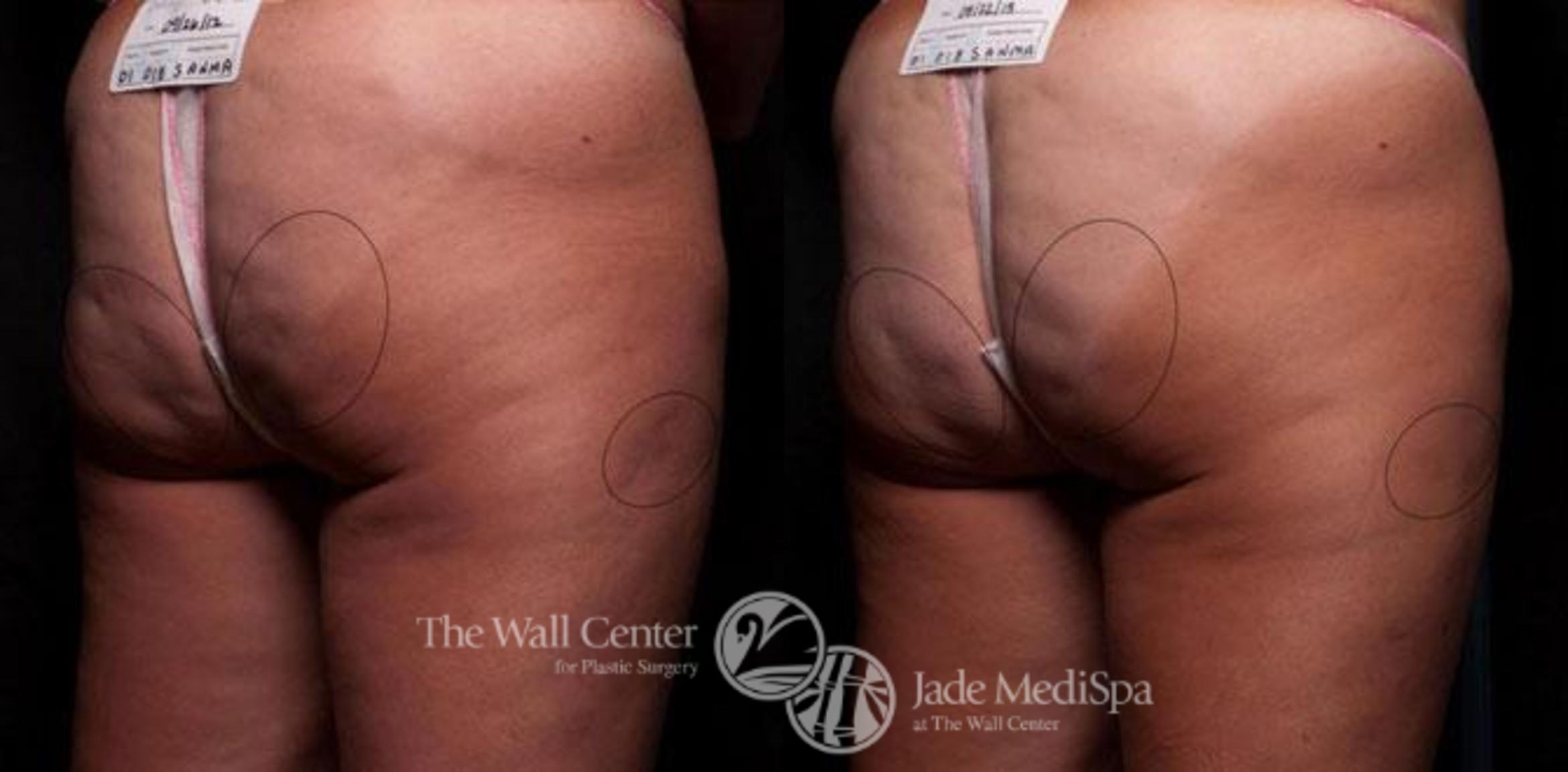 Cellfina Case 330 Before & After View #1 | Shreveport, LA | The Wall Center