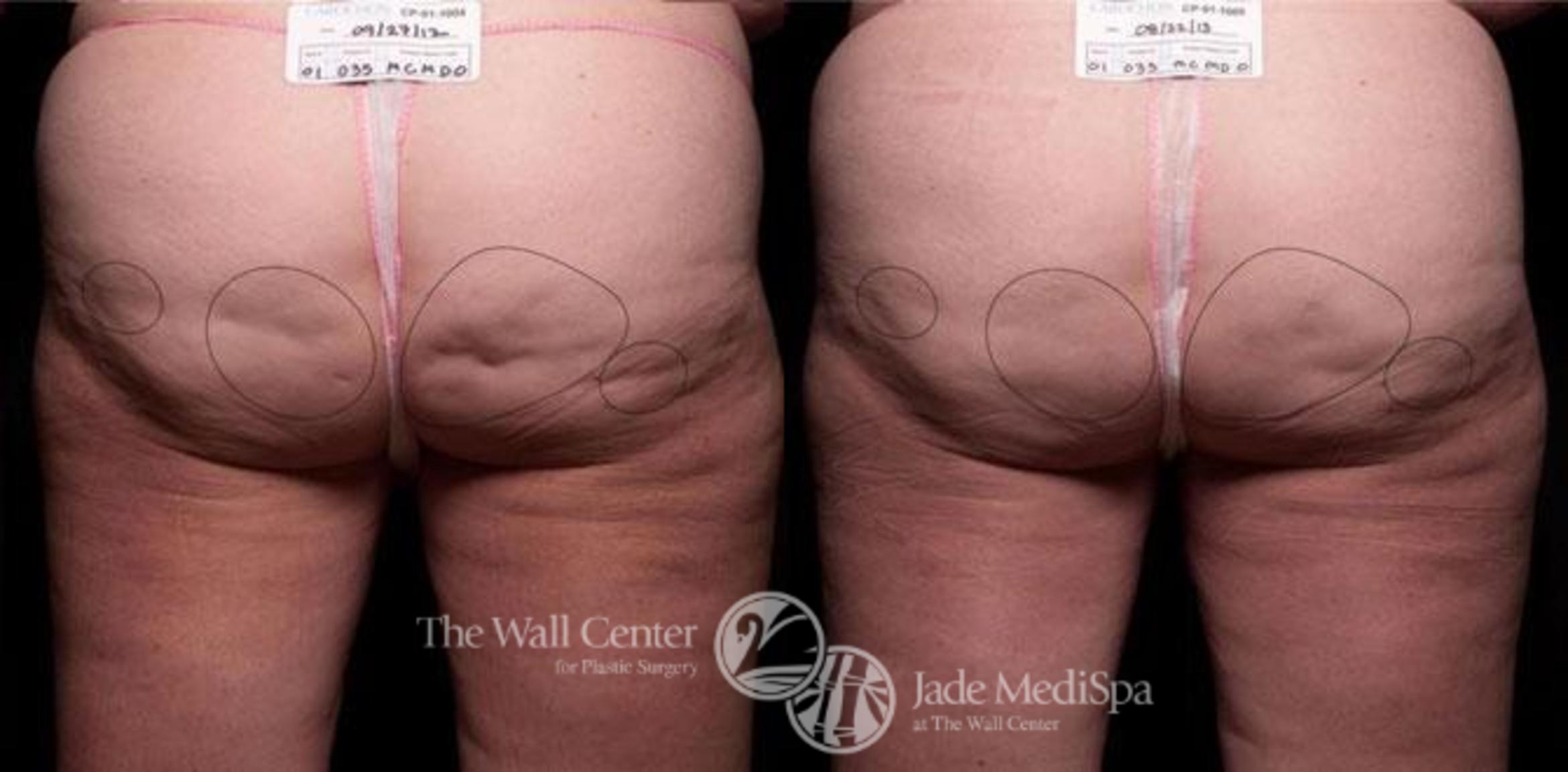 Cellfina Case 331 Before & After View #1 | Shreveport, LA | The Wall Center