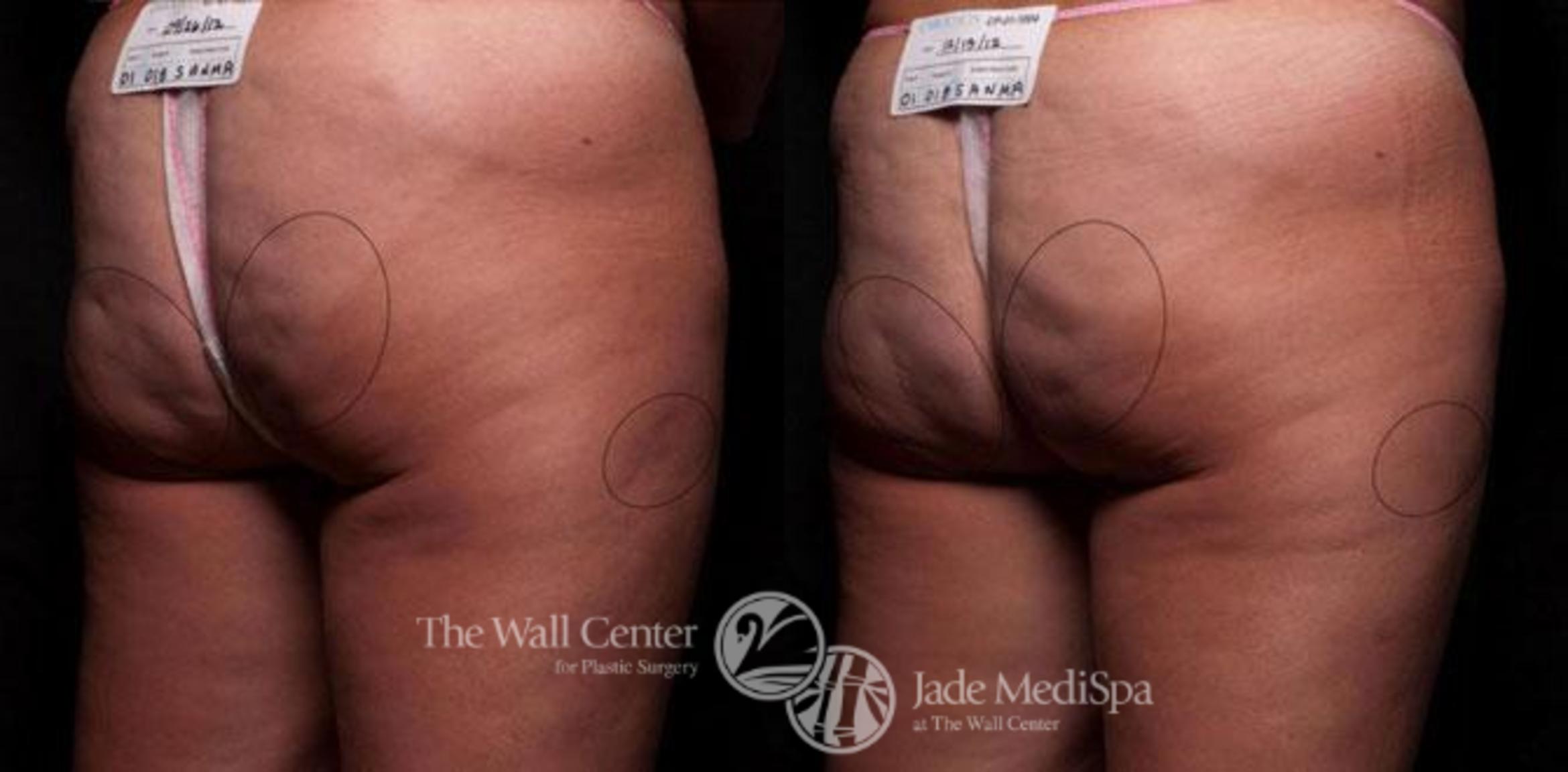 Cellfina Case 336 Before & After View #1 | Shreveport, LA | The Wall Center