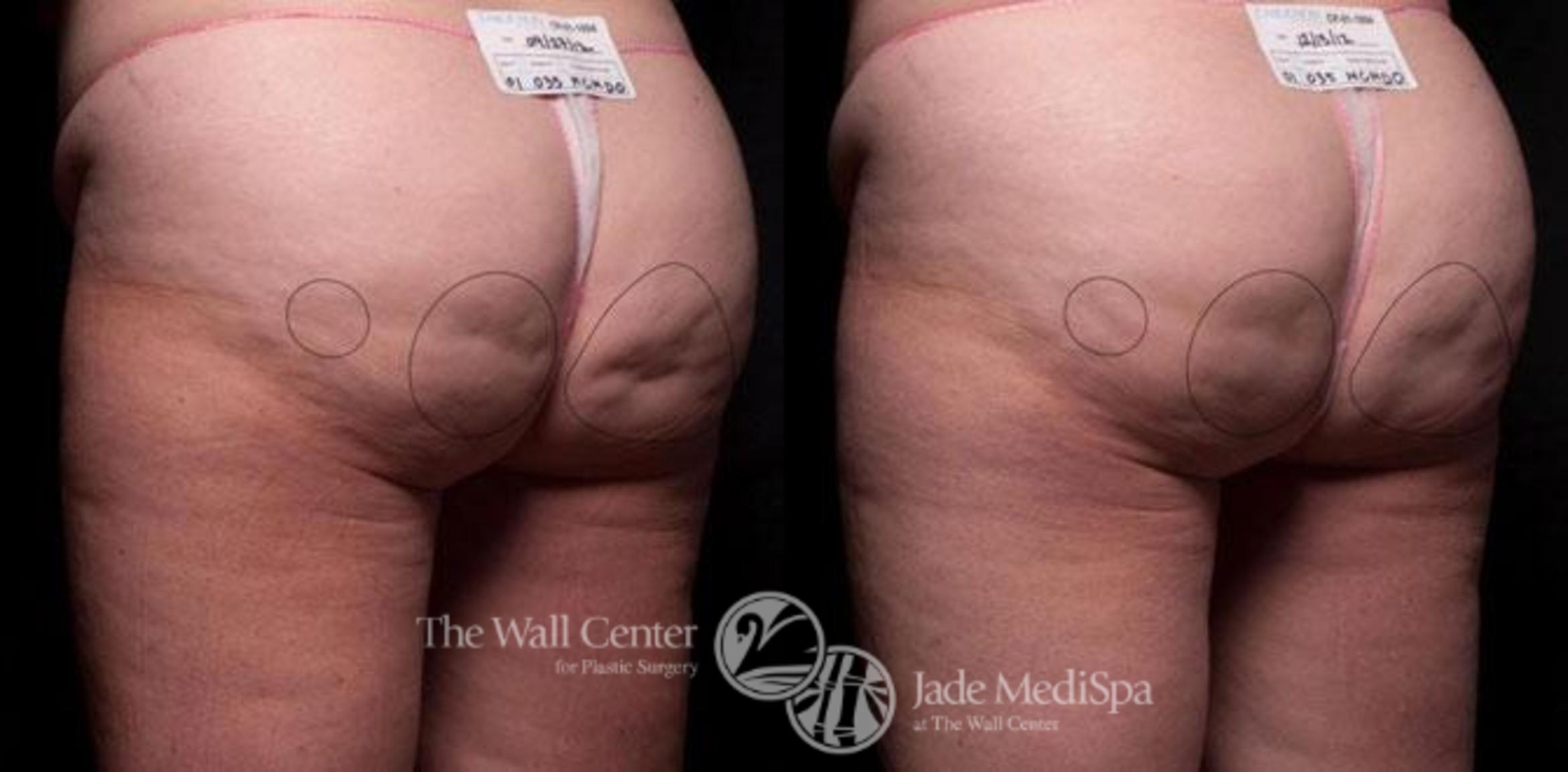 Cellfina Case 339 Before & After View #1 | Shreveport, LA | The Wall Center