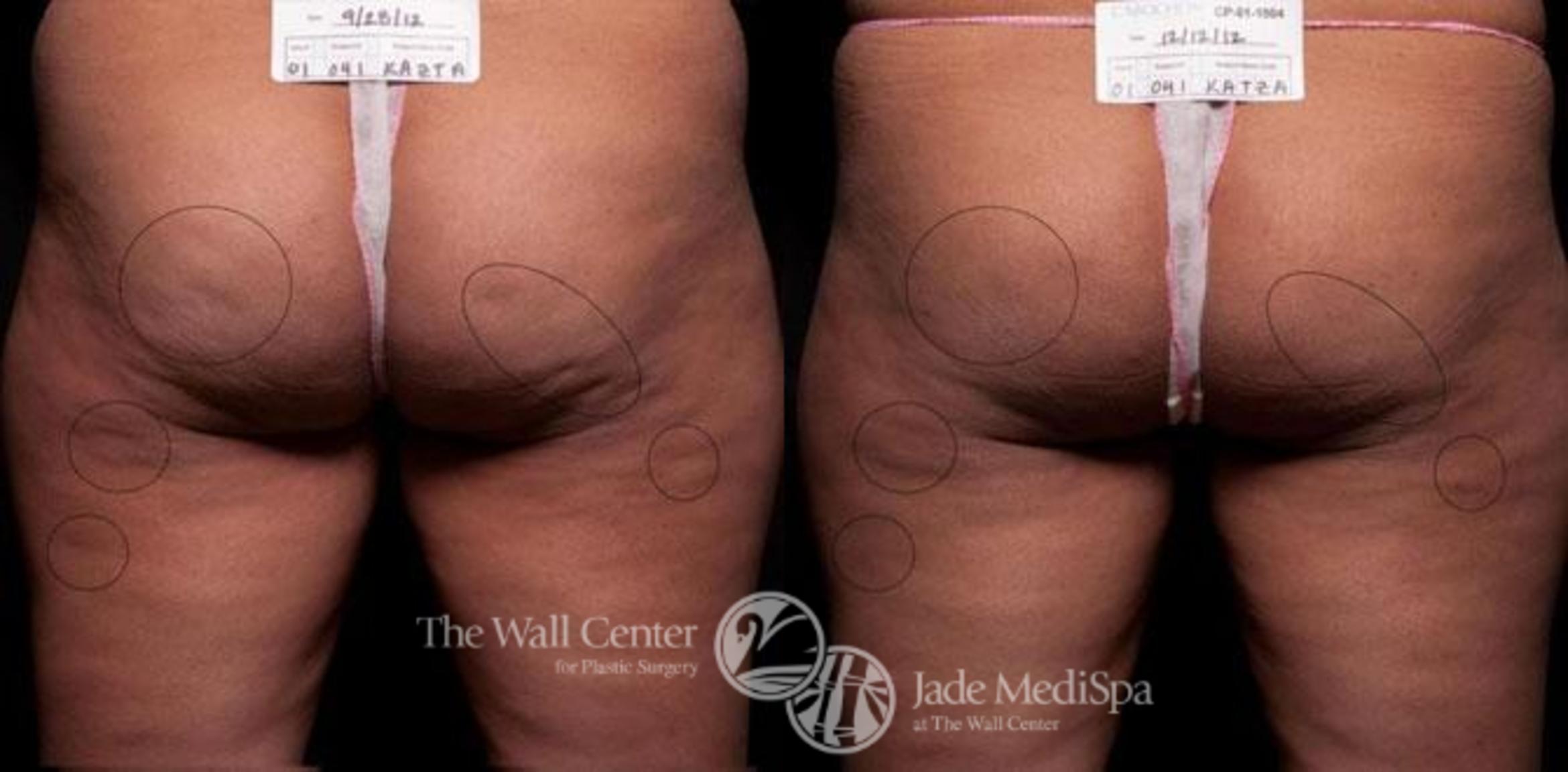 Cellfina Case 341 Before & After View #1 | Shreveport, LA | The Wall Center