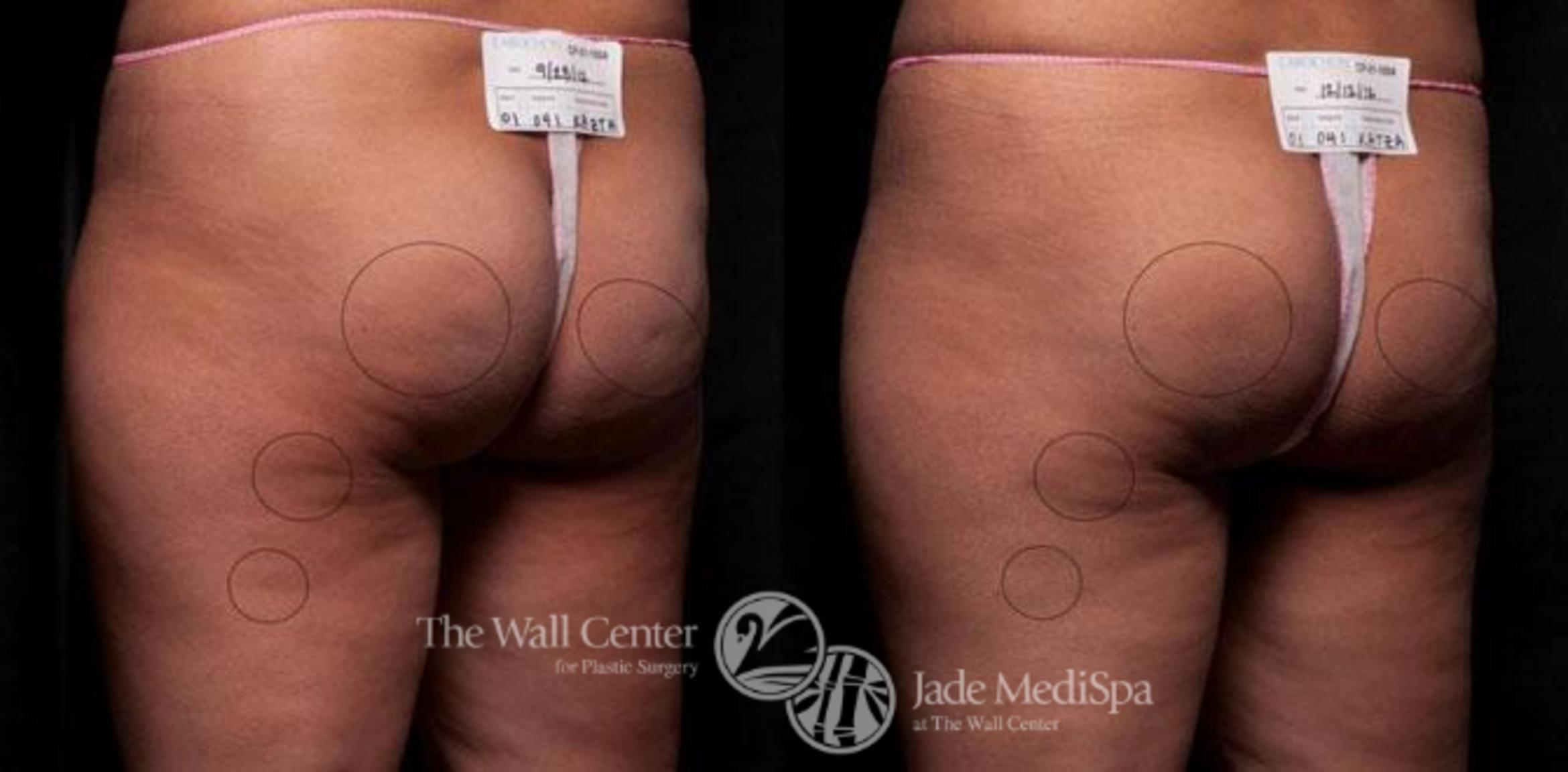 Cellfina Case 342 Before & After View #1 | Shreveport, LA | The Wall Center