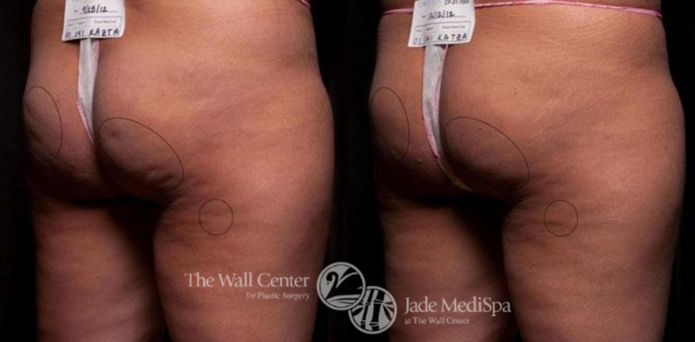 Cellfina Case 343 Before & After View #1 | Shreveport, LA | The Wall Center