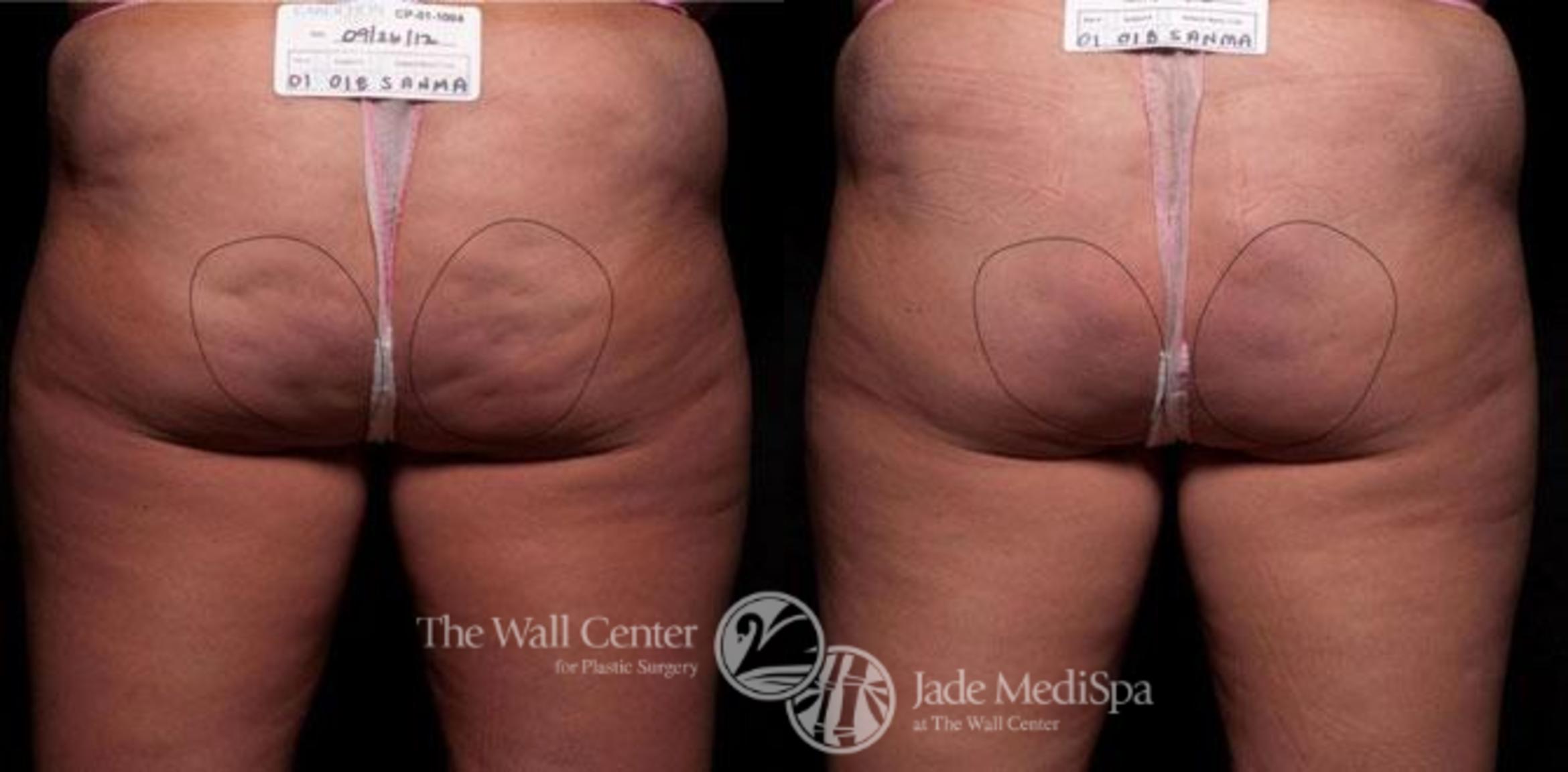 Cellfina Case 344 Before & After View #1 | Shreveport, LA | The Wall Center