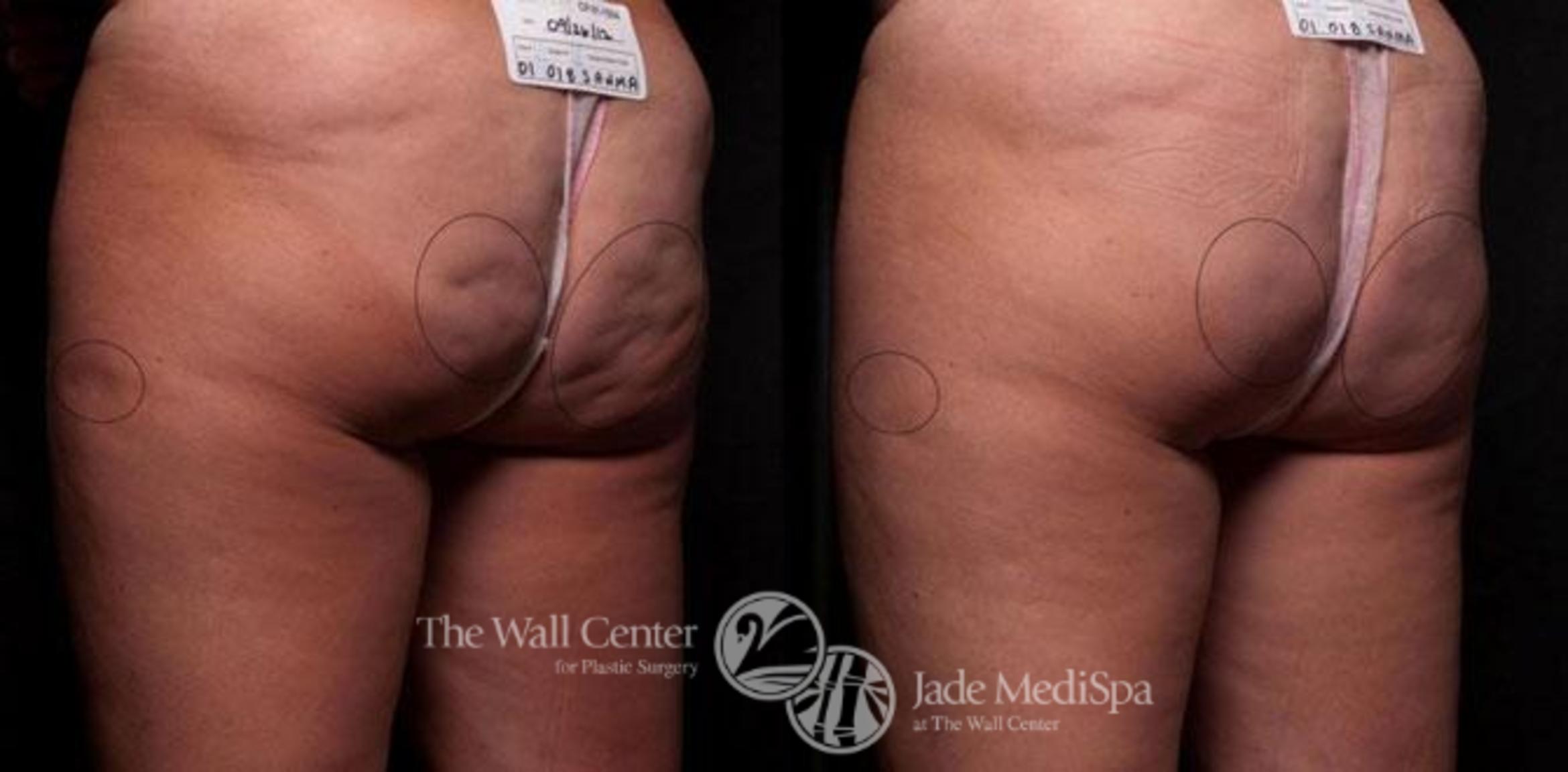 Cellfina Case 345 Before & After View #1 | Shreveport, LA | The Wall Center