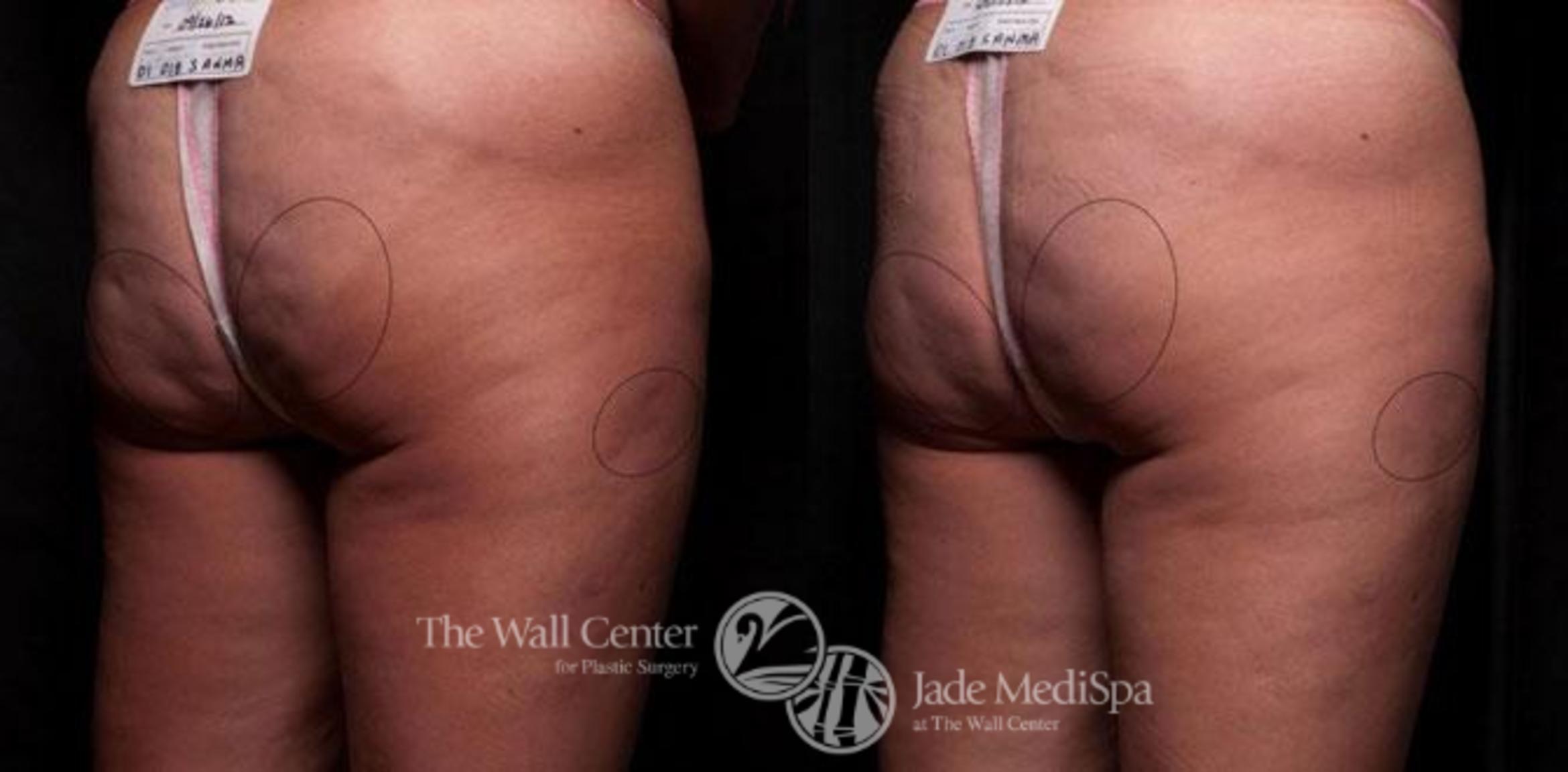 Cellfina Case 346 Before & After View #1 | Shreveport, LA | The Wall Center