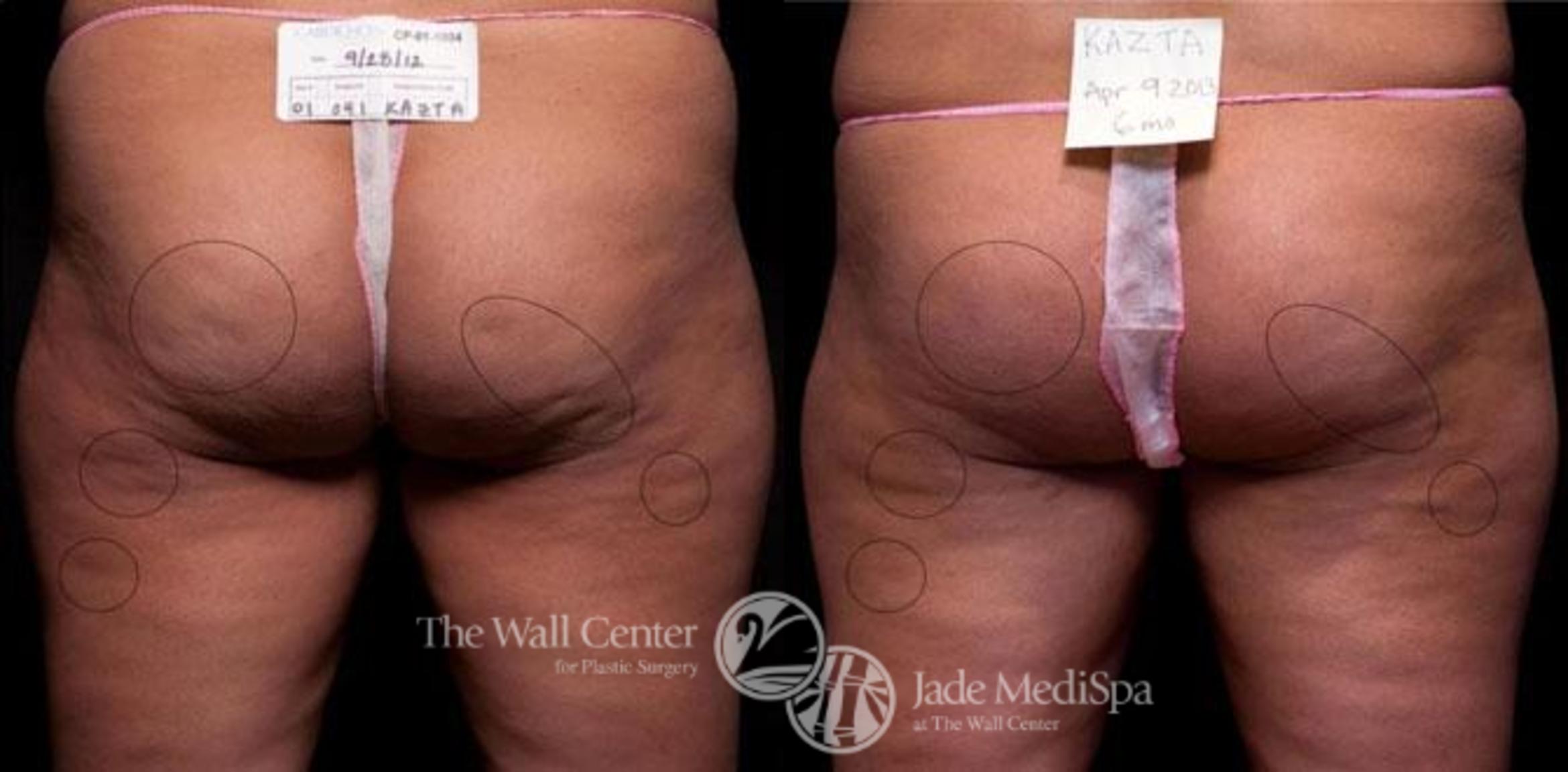 Cellfina Case 350 Before & After View #1 | Shreveport, LA | The Wall Center