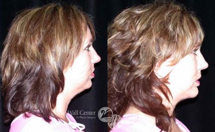 Before & After Cheek/Chin Augmentation Case 187 View #2 View in Shreveport, LA