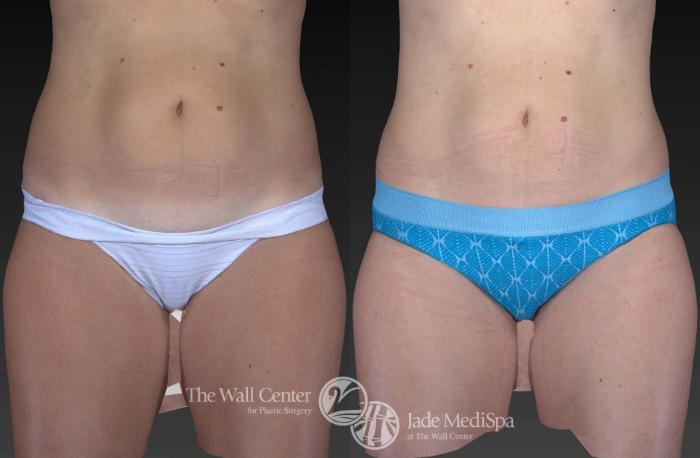 Before & After CoolSculpting Case 737 VIEW #2 View in Shreveport, LA