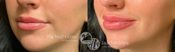 Before & After Dermal Fillers Case 1235 Left Oblique View in Shreveport, LA