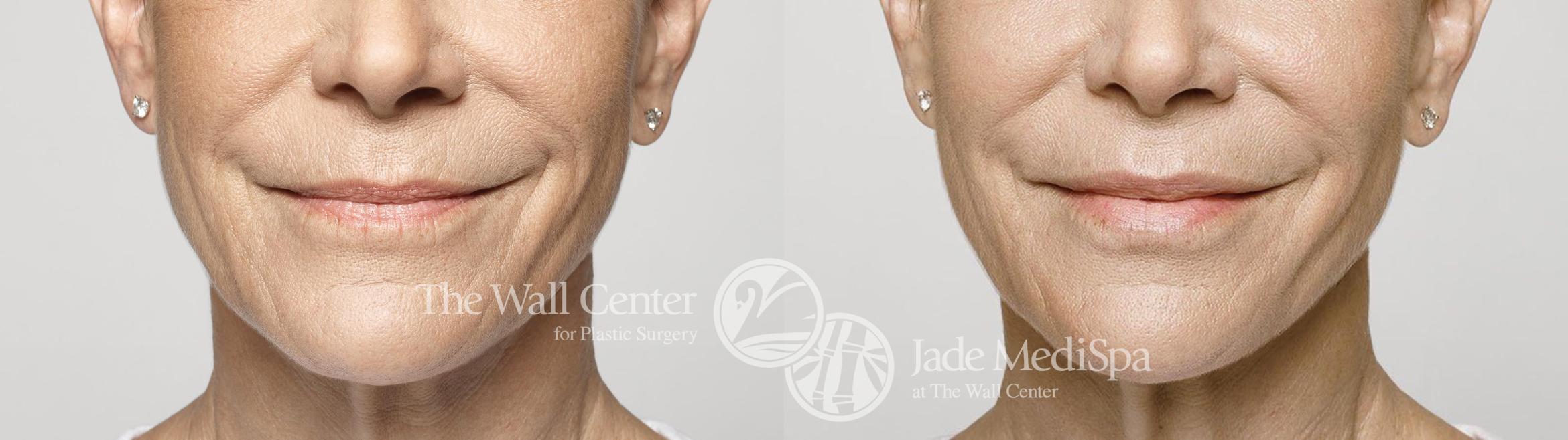 Dermal Fillers Case 395 Before & After View #1 | Shreveport, LA | The Wall Center