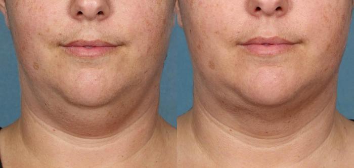 Before & After Double Chin Reduction Case 519 View #2 View in Shreveport, LA