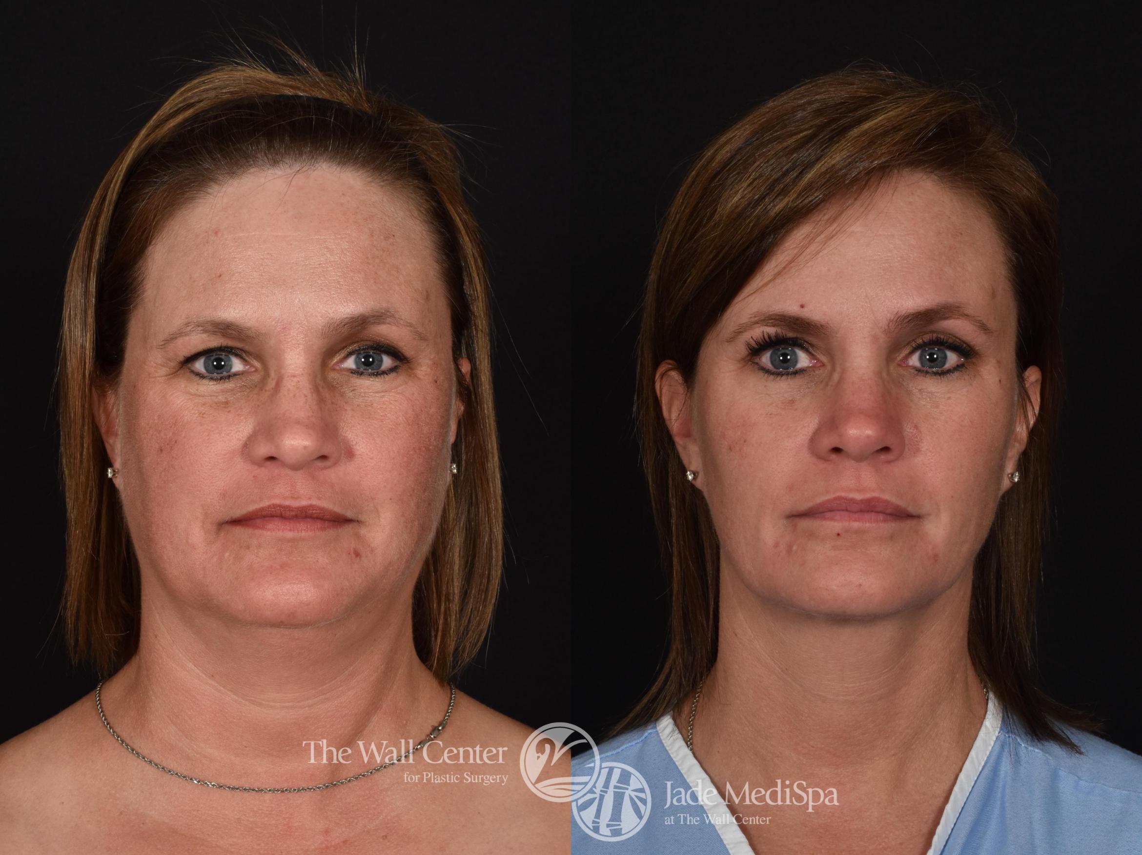 Before & After Double Chin Reduction Case 725 VIEW #1 View in Shreveport, LA