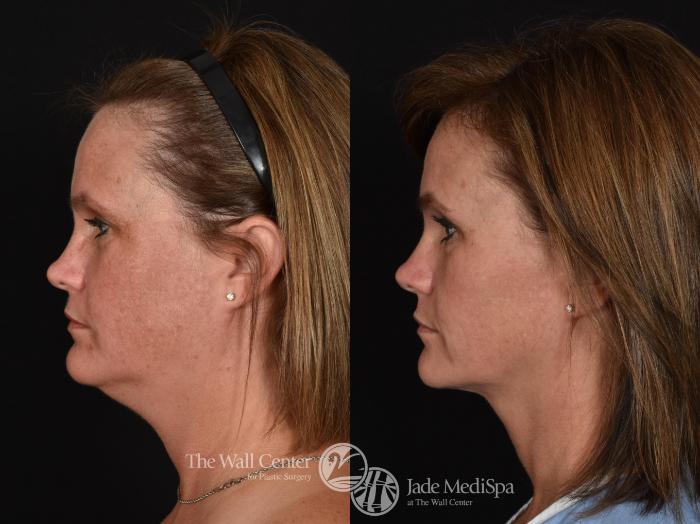 Before & After Double Chin Reduction Case 725 VIEW #3 View in Shreveport, LA