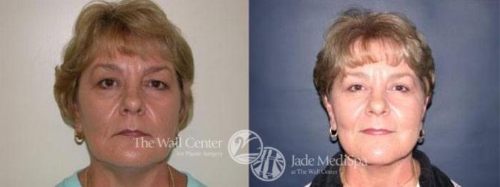Before & After Eyelid Surgery Case 185 View #1 View in Shreveport, LA