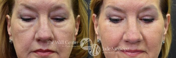 Before & After Eyelid Surgery Case 574 View #3 View in Shreveport, LA