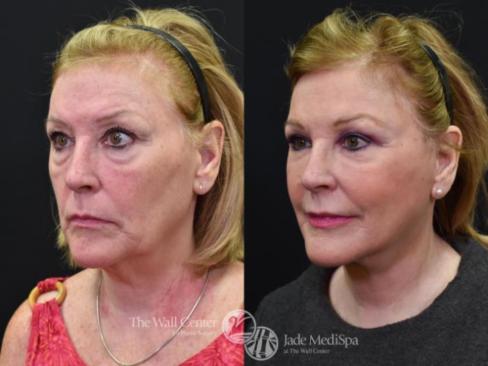 Before & After Facelift Case 579 View #2 View in Shreveport, LA