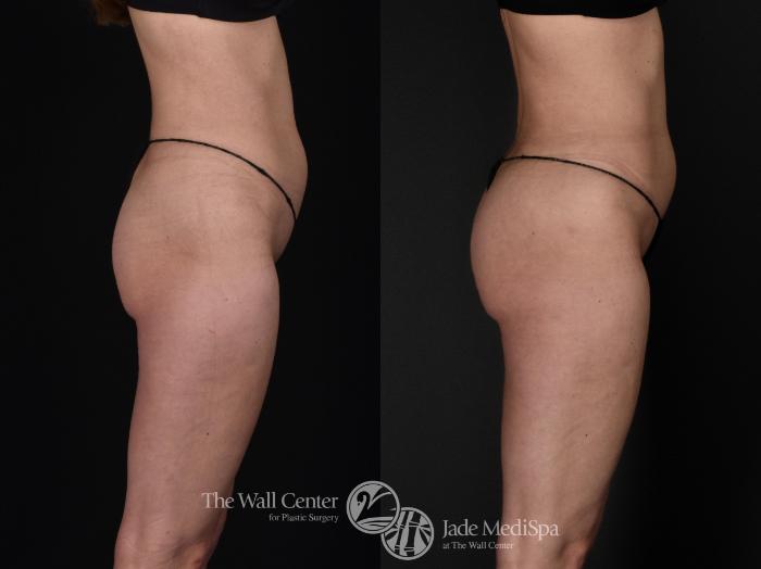 Before & After Fat Grafting – Buttocks Case 571 View #3 View in Shreveport, LA