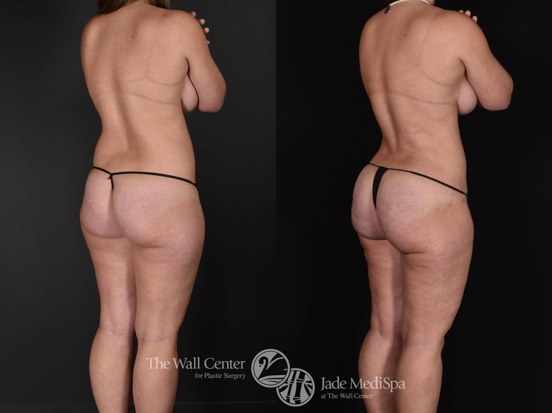 Before & After Fat Grafting – Buttocks Case 724 VIEW #1 View in Shreveport, LA