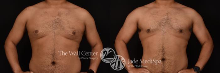 Before & After Male Breast Reduction Case 1108 Front View in Shreveport, LA
