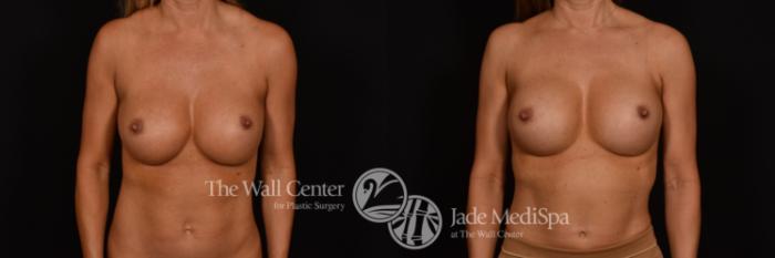 Before & After Redo Surgery/Problem Cases Case 1077 Front View in Shreveport, LA
