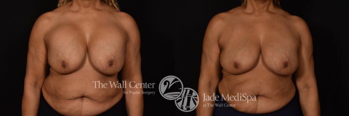 Before & After Redo Surgery/Problem Cases Case 1081 Front View in Shreveport, LA