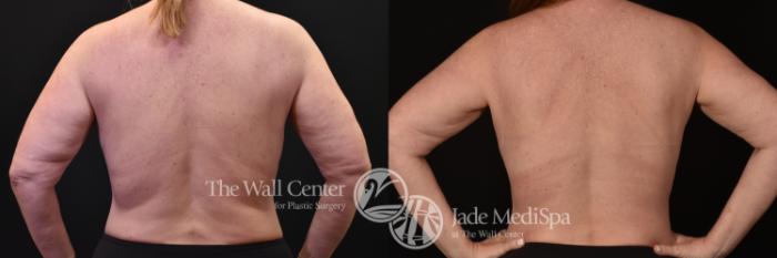 Before & After SAFELipo™ Case 1111 Back View in Shreveport, LA