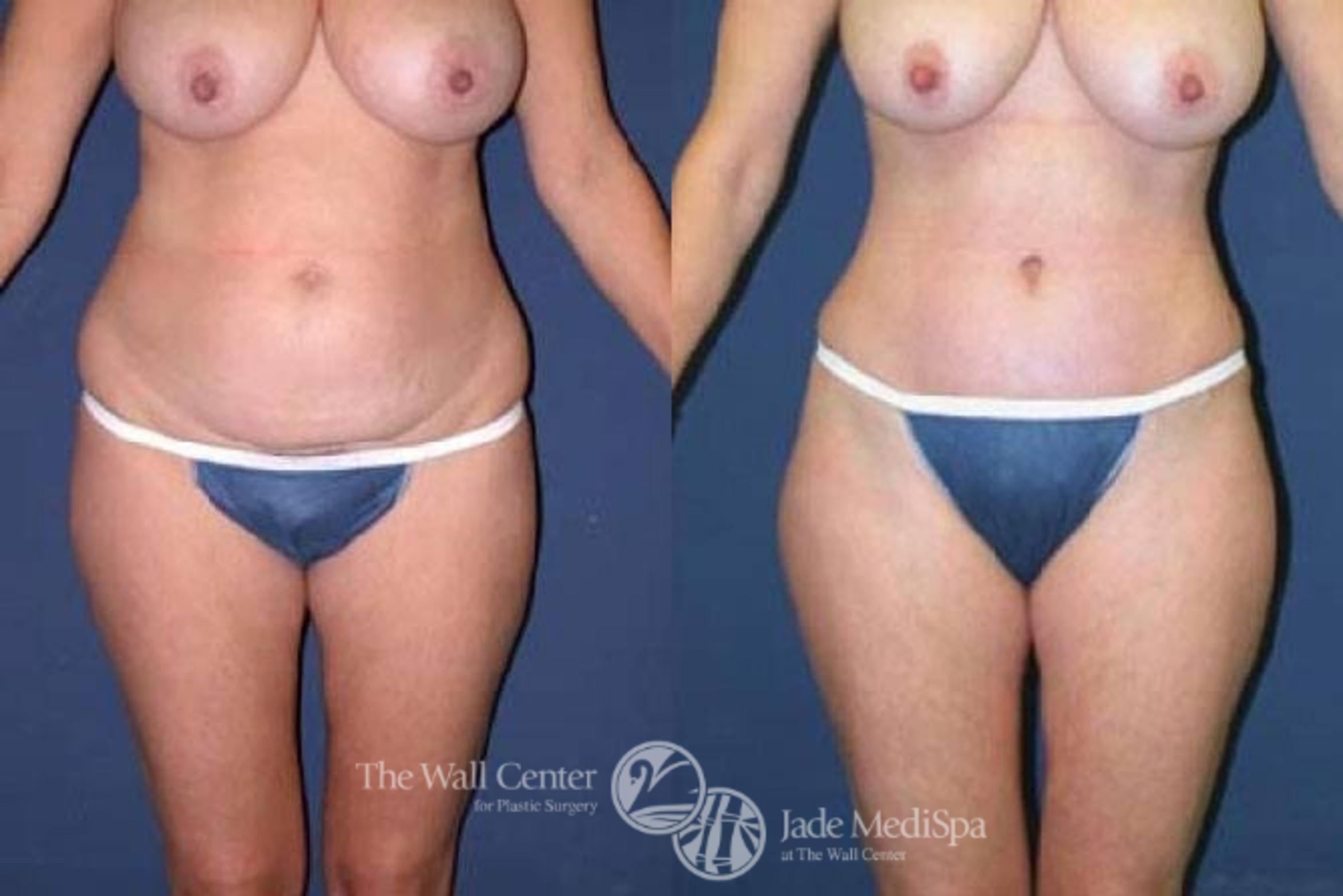 Before & After SAFELipo™ Case 75 View #1 View in Shreveport, LA