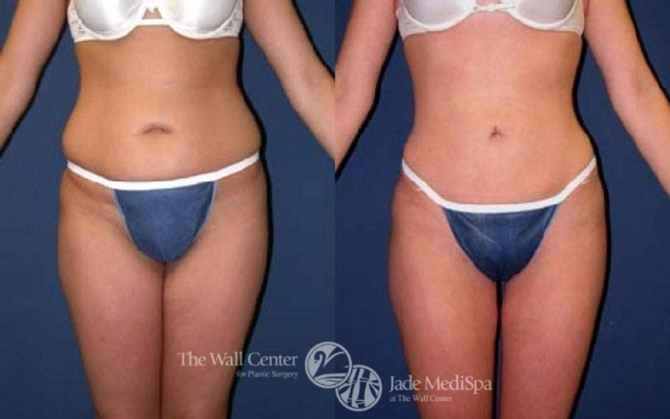 Before & After SAFELipo™ Case 76 View #1 View in Shreveport, LA