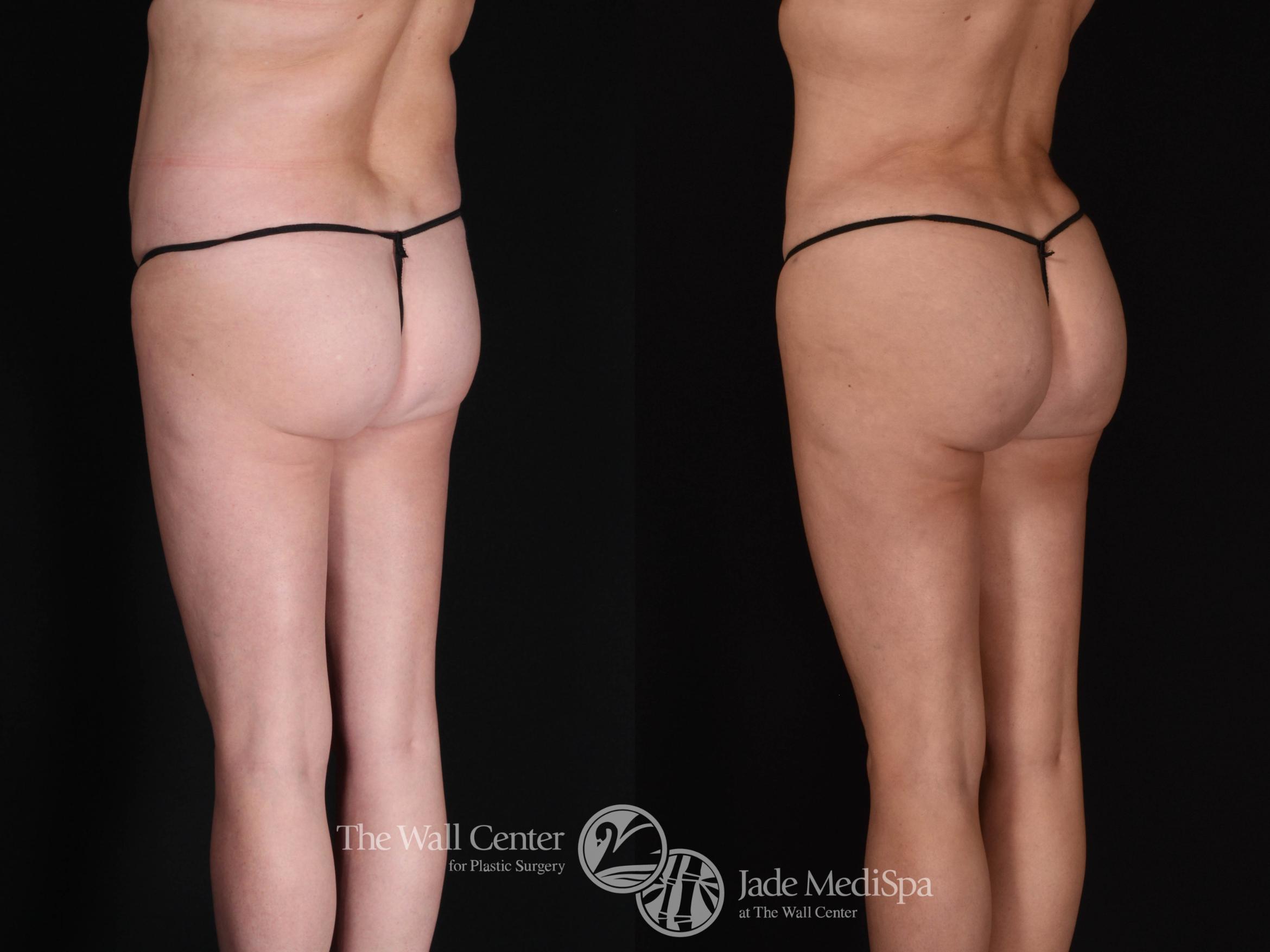 SAFELipo with Fat Grafting to Buttocks Back Left Oblique Photo, Shreveport, Louisiana, The Wall Center for Plastic Surgery, Case 930