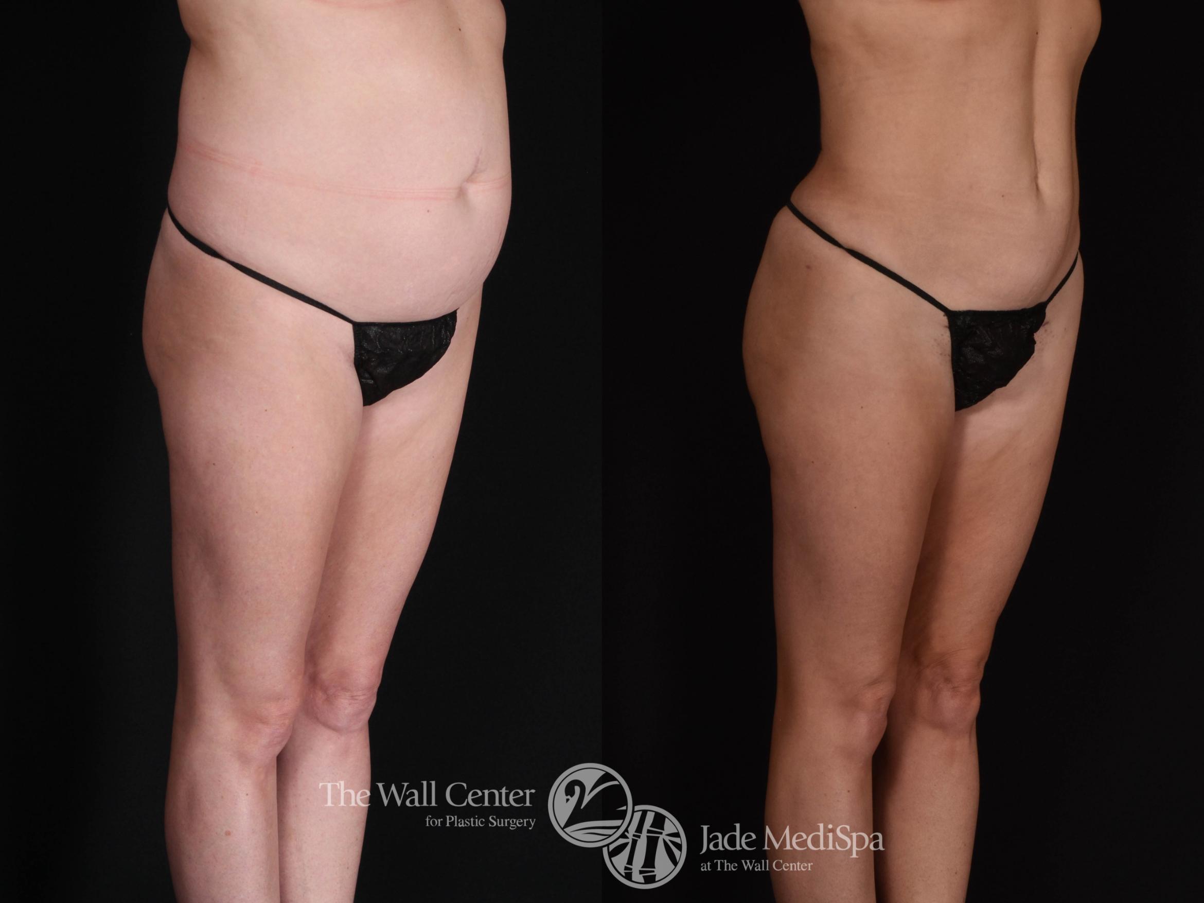 SAFELipo with Fat Grafting to Buttocks Right Oblique Photo, Shreveport, Louisiana, The Wall Center for Plastic Surgery, Case 930