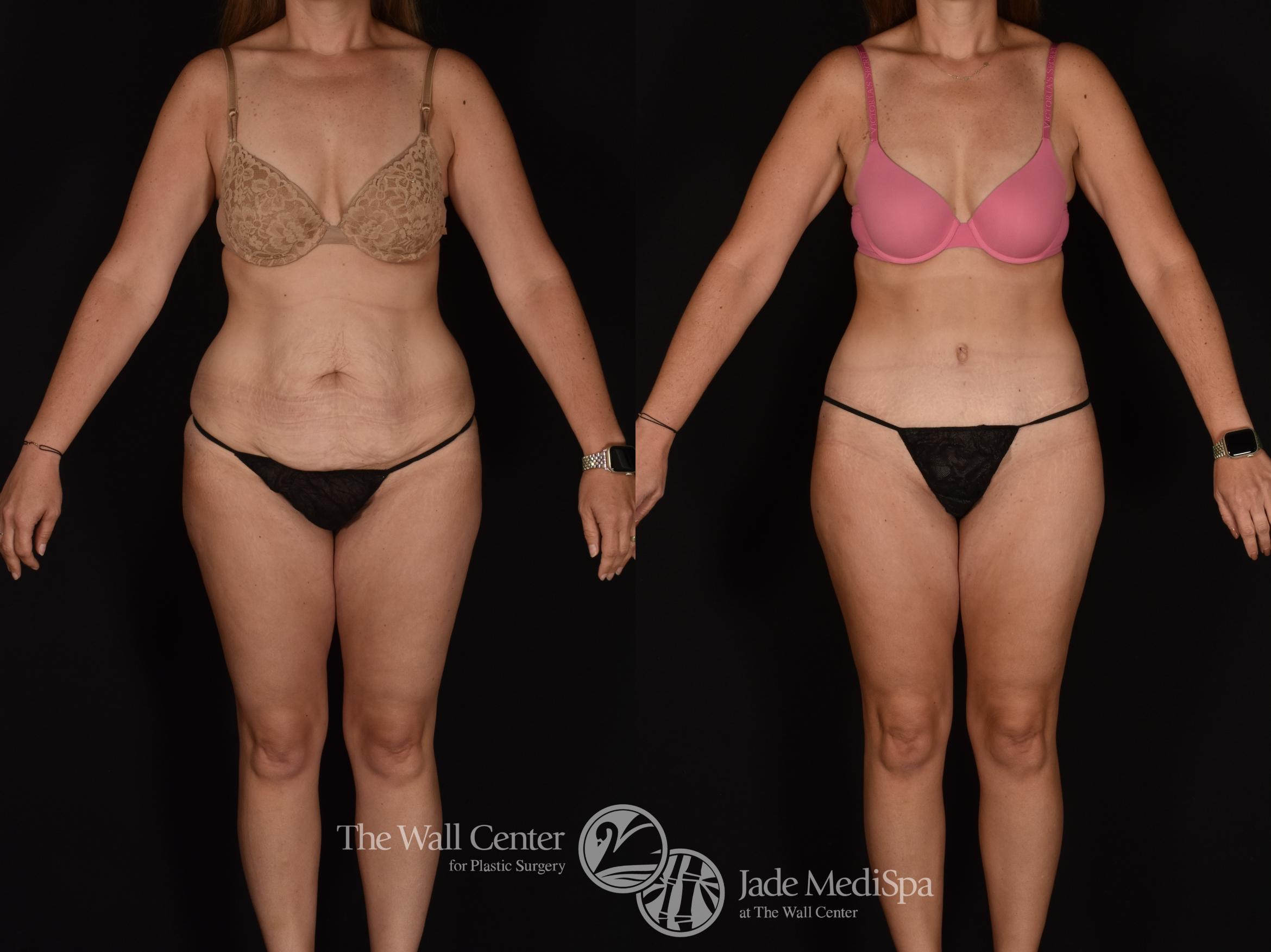Before & After Tummy Tuck Case 1163 Front View in Shreveport, LA