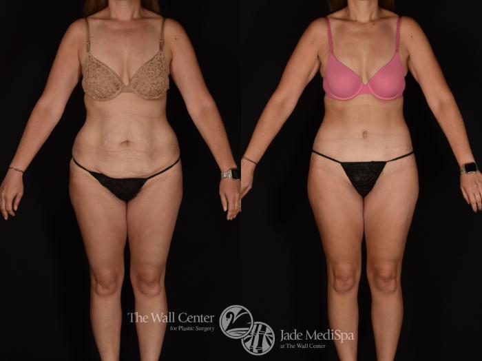 Before & After Tummy Tuck Case 1163 Front View in Shreveport, LA