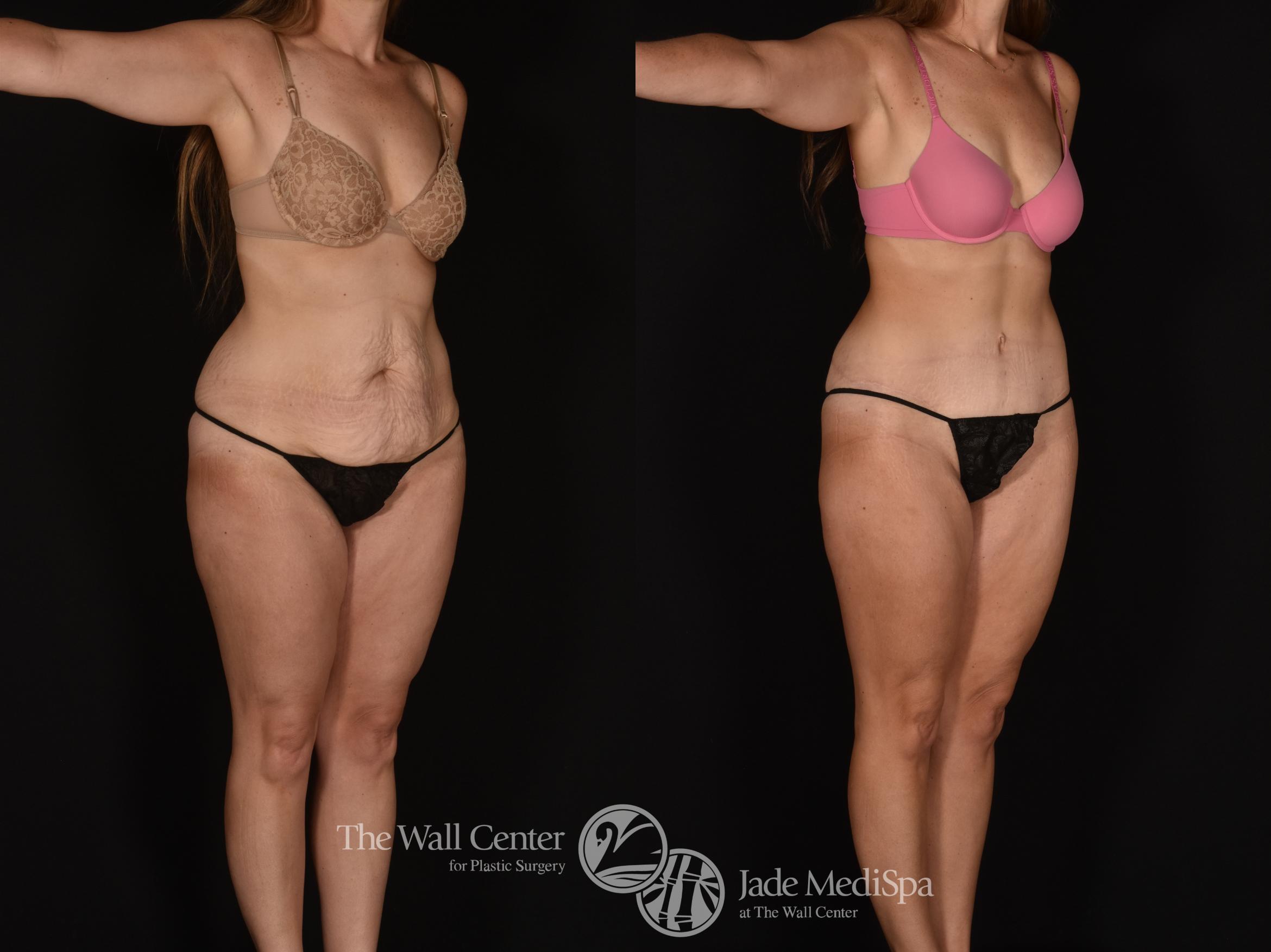 Before & After Tummy Tuck Case 1163 Right Oblique View in Shreveport, LA