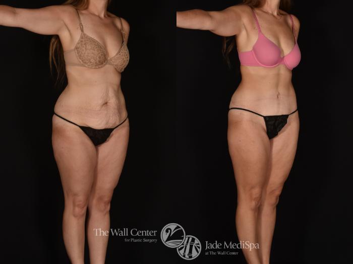 Before & After Tummy Tuck Case 1163 Right Oblique View in Shreveport, LA