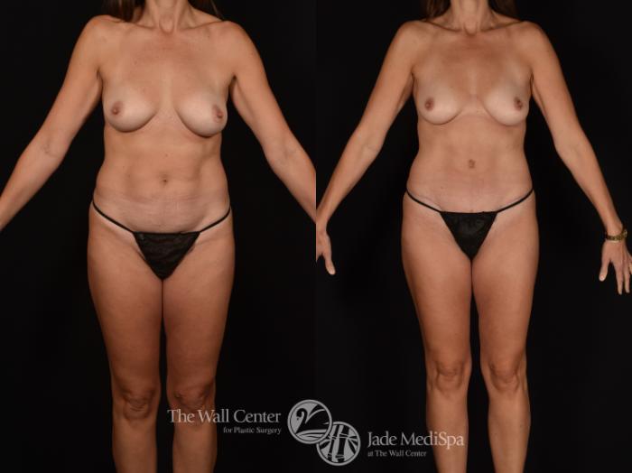 Before & After Tummy Tuck Case 1258 Front View in Shreveport, LA