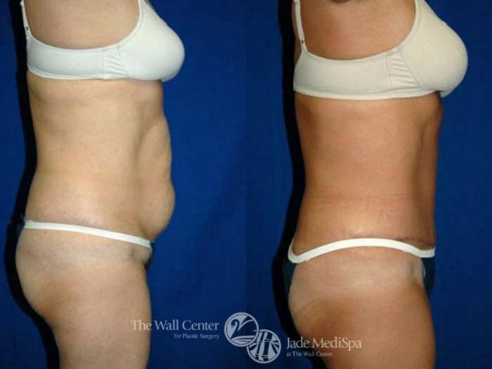 Before & After Tummy Tuck Case 148 View #3 View in Shreveport, LA