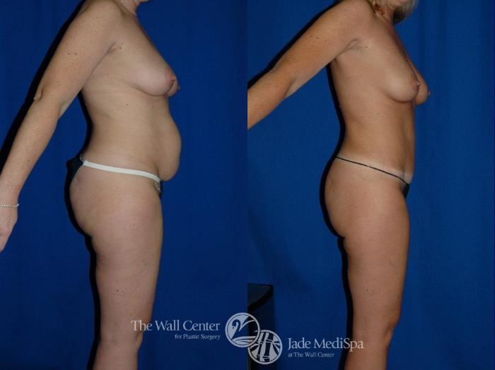 Before & After Tummy Tuck Case 16 View #1 View in Shreveport, LA